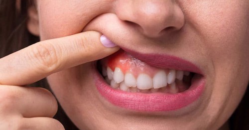 Tại sao lợi mỏng lộ chân răng? Cách nào giúp cải thiện lợi mỏng lộ chân răng?